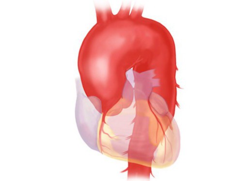 Anatomie der Aorta 