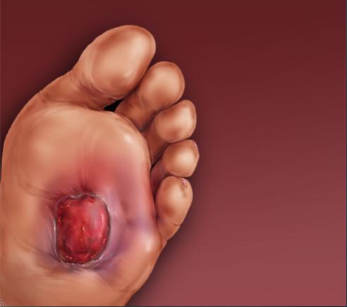 Diabetischer Fuß: Symptome und Klassifizierung