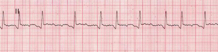 Vorhofflimmern im EKG. Vorhofflattern