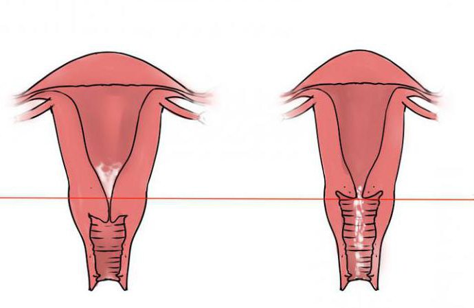 Muskelhypertrophie des Gebärmutterhalses 