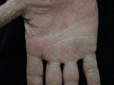 Wie behandelt man Ekzeme an den Händen und was ist es?