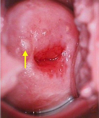 Wie sieht der Gebärmutterhals vor der Menstruation aus?