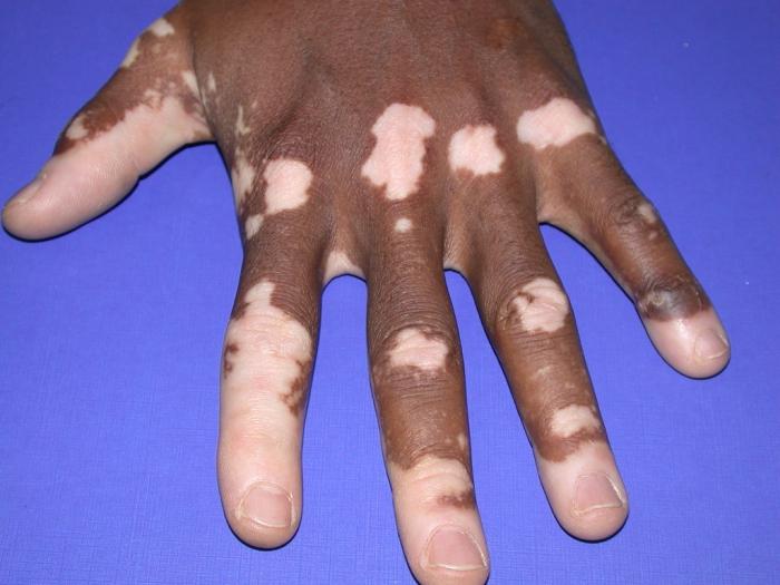 Was sind die Symptome und Ursachen von Vitiligo?