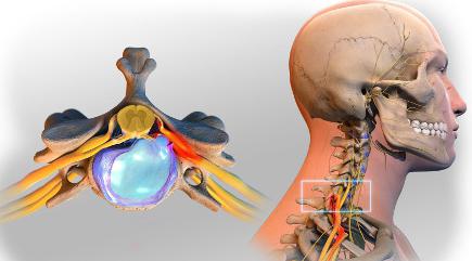 zervikale Hernie