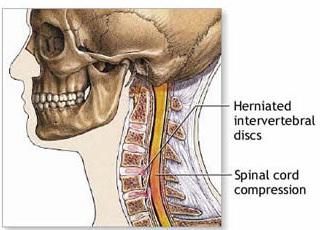 Hernie in der Halswirbelsäule