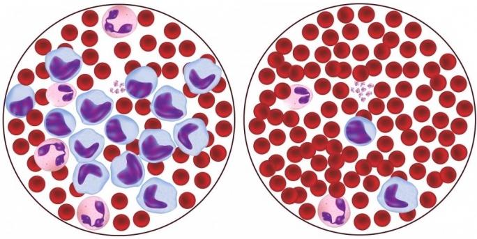 Erhöhte Lymphozyten: Wer ist schuld und was zu tun?