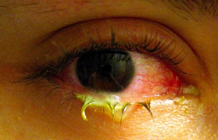 Symptome einer Konjunktivitis 