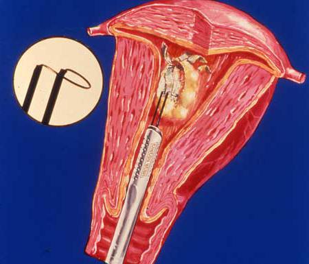 Polypen in Uterus Entfernung Bewertungen